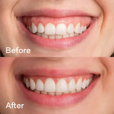 تفاوت قبل و بعد اصلاح لبخند لثه‌ای با جراحی زیبایی دندان