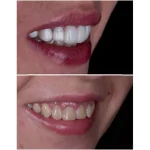 کامپوزیت دندان