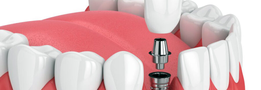عوامل مؤثر بر موفقیت ایمپلنت دندان