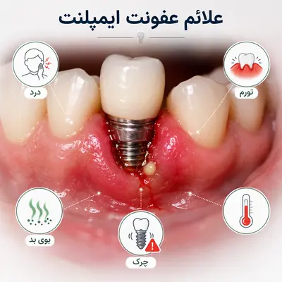 علائم عفونت ایمپلنت؛ درد، تورم و چرک