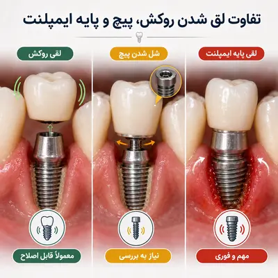 تفاوت لق شدن روکش، پیچ و پایه ایمپلنت