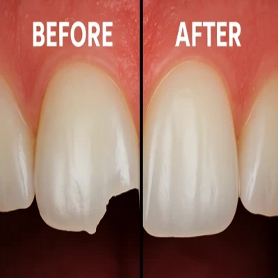 بازسازی لب‌پریده دندان جلو با ظاهر طبیعی و درخشان