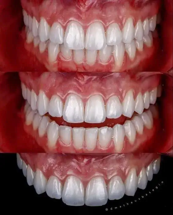 مقایسه لمینت و کامپوزیت دندان