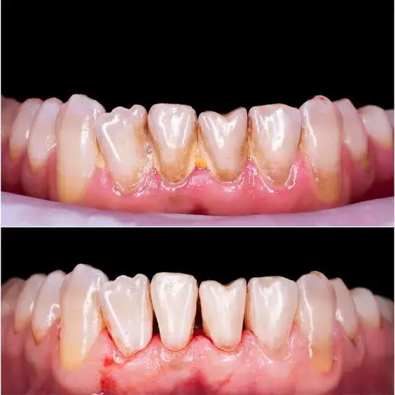 درمان بیماری لثه: قبل و بعد از جرمگیری