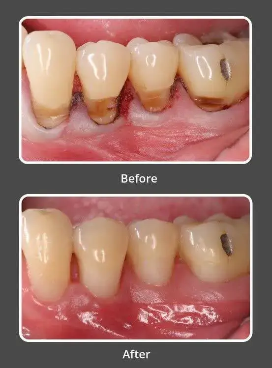 پیشرفت بیماری لثه و تحلیل لثهها