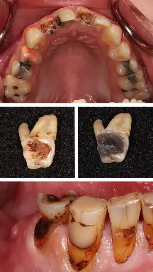 راه‌های پیشگیری از پوسیدگی دندان