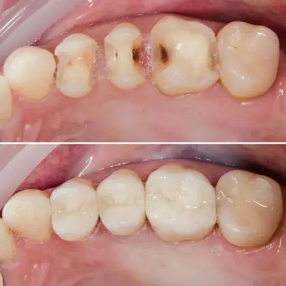 پوسیدگی دندان را متوقف کنید! نکاتی که دندانپزشکان توصیه می‌کنند