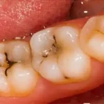 راه‌های پیشگیری از پوسیدگی دندان