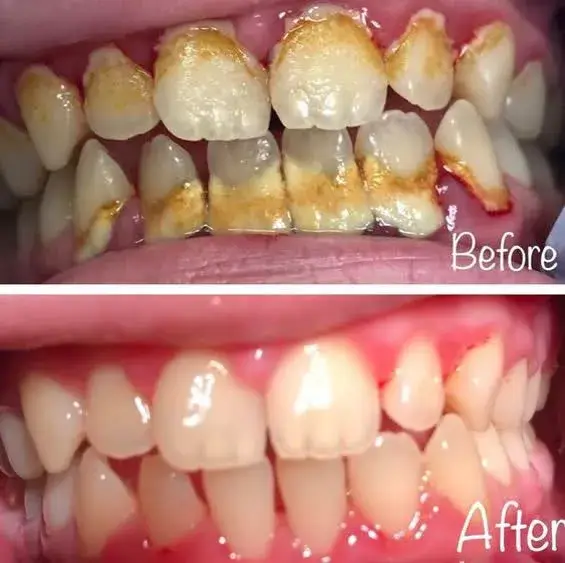 چگونه از بوی بد دهان خلاص شویم؟ ۱۰ روش ثابت‌شده