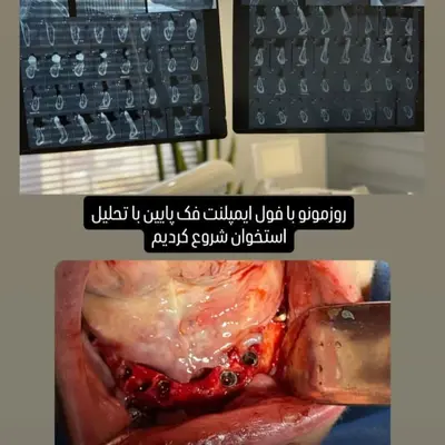 بررسی CBCT قبل از فول ایمپلنت فک پایین با تحلیل استخوان