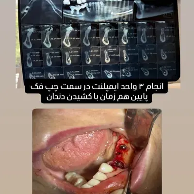 کاشت ۳ ایمپلنت فک پایین همزمان با کشیدن دندان