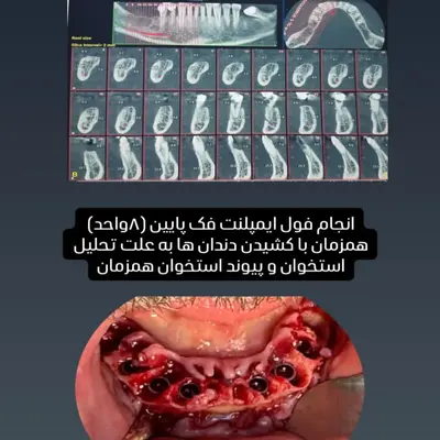 عکس CBCT و کاشت ۸ ایمپلنت فک پایین همزمان با کشیدن دندان