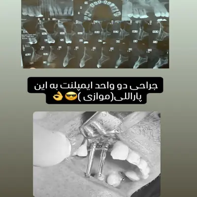 بررسی تراکم استخوان با CBCT پیش از کاشت دو ایمپلنت
