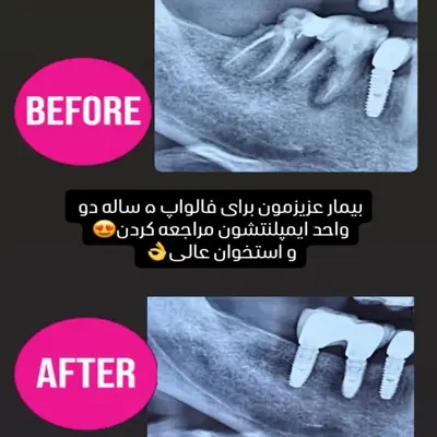 رادیوگرافی ایمپلنت موفق پس از ۵ سال؛ استخوان سالم مانده
