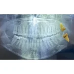 کشیدن دندان عقل