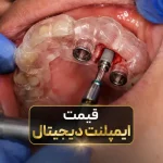 قیمت ایمپلنت دیجیتال در تهران ۱۴۰۵