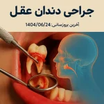 جراحی دندان عقل