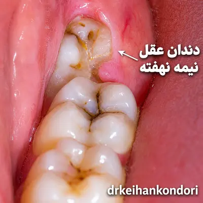 عکس دندان عقل نهفته
