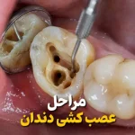 مراحل عصب کشی دندان
