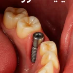 ایمپلنت ونک