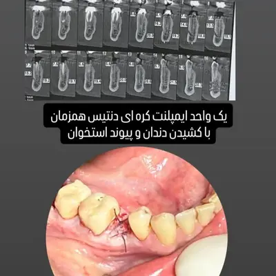 پیوند استخوان اطراف فیکسچر در ایمپلنت فوری
