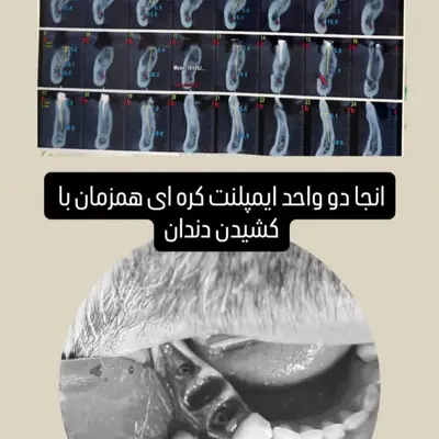 کشیدن دندان پیش از کاشت در ایمپلنت فوری