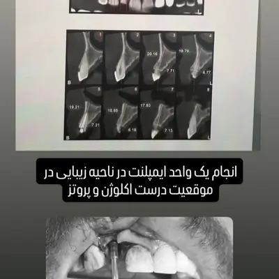 عکس CBCT برای اندازهگیری استخوان پیش از ایمپلنت فوری