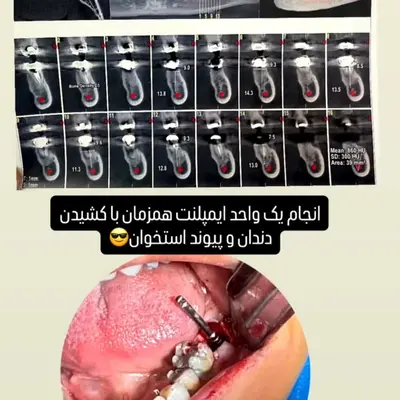 قرار گرفتن فیکسچر در حفرهٔ تازه حین ایمپلنت فوری