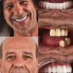 مراحل ایمپلنت دندان+عکس ایمپلنت دندان قبل و بعد