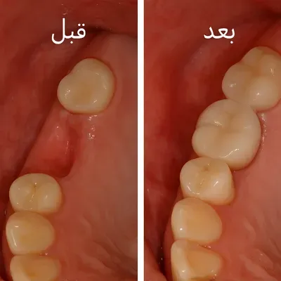 تفاوت لبخند بیمار پس از درمان تخصصی دندان