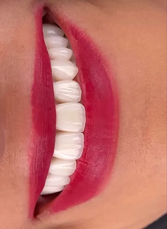 لمینت دندان: راهی سریع به لبخندی زیبا