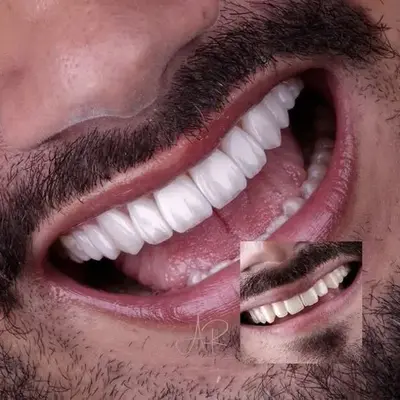 فرق لمینت و کامپوزیت