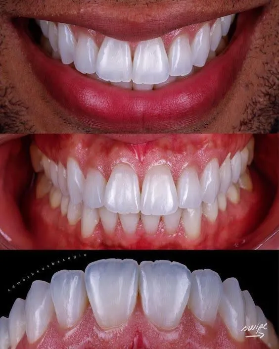 آیا لمینت دندان درد دارد؟ همه چیز درباره آن