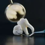 دندان عقل پوسیده: 7 علائم اصلی، 5 روش درمان قطعی و راههای پیشگیری موثر