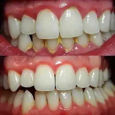 قبل و بعد جرم‌گیری؛ برداشتن جرم لبه لثه و کاهش قرمزی لثه