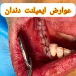 عوارض ایمپلنت دندان