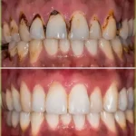 آیا جرم‌گیری دندان را سفید می‌کند یا فقط تمیزش می‌کند؟