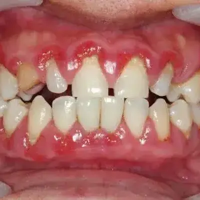 جرم قهوهای کنار خط لثه همراه با تورم و خونریزی لثه