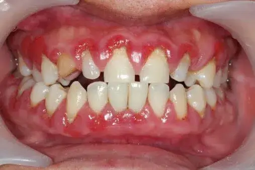 حذف جرم و رسوب برای لبخندی شفاف‌تر