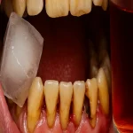 جرم‌گیری برای دندان ضرر دارد؟ بررسی علمی «مضرات جرم‌گیری دندان»