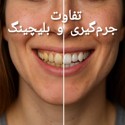 قبل و بعد انواع بلیچینگ دندان (نمونه‌نتایج واقعی)