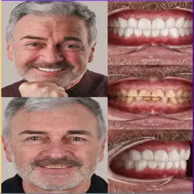 تفاوت در نتایج ایمپلنت سوئیسی و کره‌ای در طراحی دندان‌ها