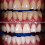 انواع بلیچینگ دندان
