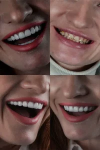 بلیچینگ دندان چیست؟ مقایسه روش‌های مختلف