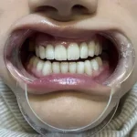 قیمت لمینت دندان در تهران ۱۴۰۵؛ هزینه لمینت دندان برای فک بالا و دو فک