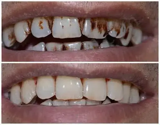تصاویر واقعی جرم‌گیری؛ آیا جرم گیری دندان را نازک میکند؟