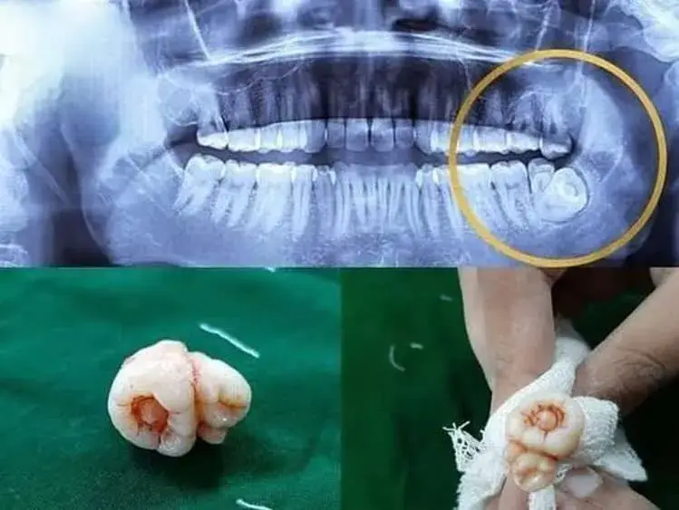 جراحی دندان عقل نهفته