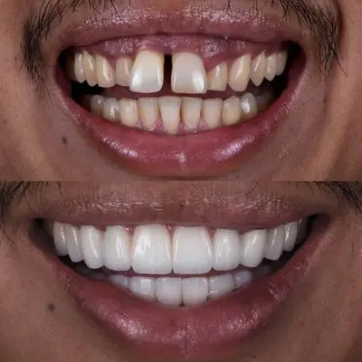 بستن فاصله دندان‌ها با ونیر و روکش زیبایی