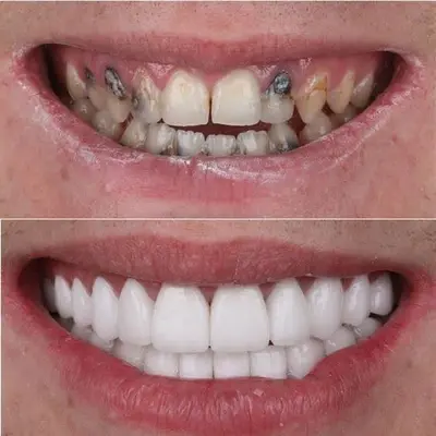 قبل و بعد تغییر لبخند با هزینه ونیر