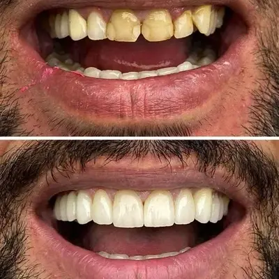 طرح لبخند جدید با روکش سرامیکی طبیعی